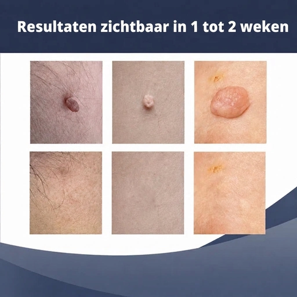 SkinClear™ | Kit Anti-Acrochordons à Domicile