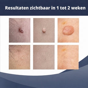 SkinClear™ | Kit Anti-Acrochordons à Domicile