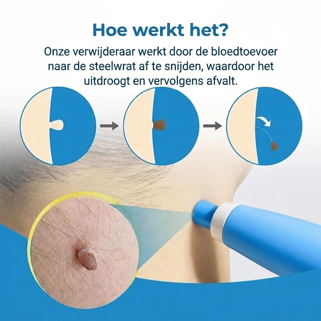 SkinClear™ | Kit Anti-Acrochordons à Domicile