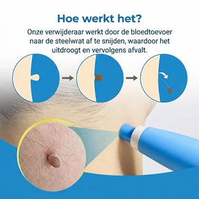 SkinClear™ | Kit Anti-Acrochordons à Domicile