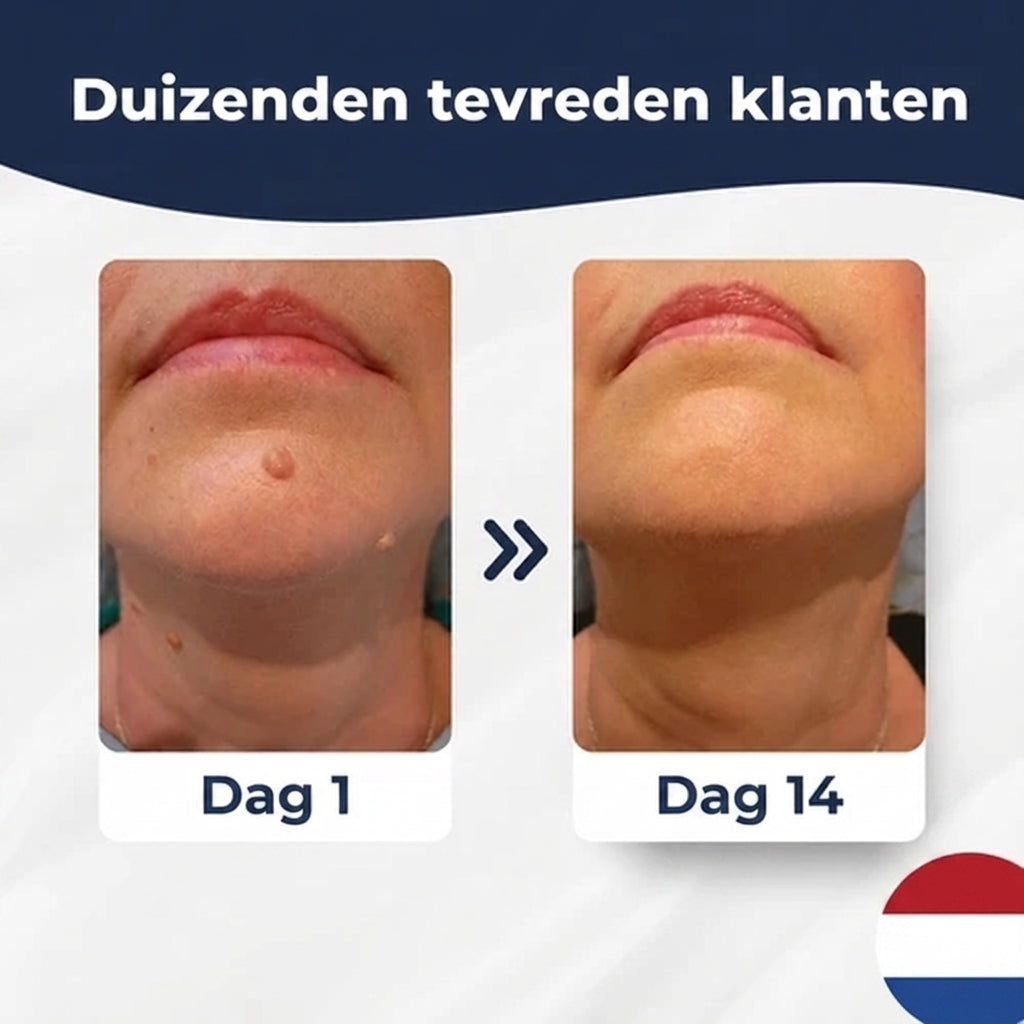 SkinClear™ | Kit Anti-Acrochordons à Domicile