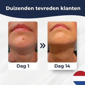 SkinClear™ | Kit Anti-Acrochordons à Domicile