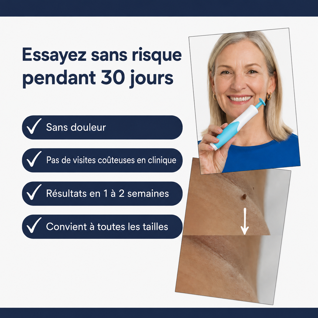 SkinClear™ | Kit Anti-Acrochordons à Domicile