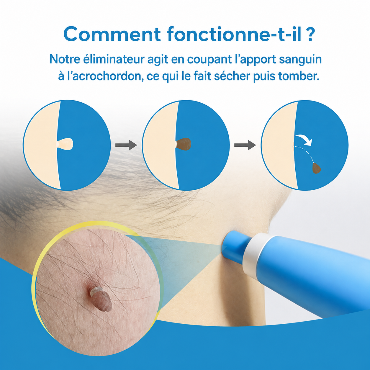 SkinClear™ | Kit Anti-Acrochordons à Domicile